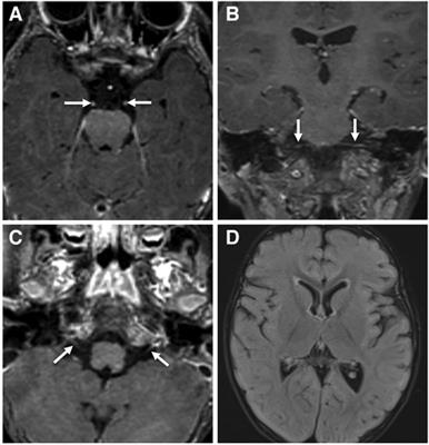 Case Report: A rare treatable metabolic syndrome (Brown-Vialetto-Van Laere syndrome) masquerading as chronic inflammatory demyelinating polyneuropathy from Saudi Arabia